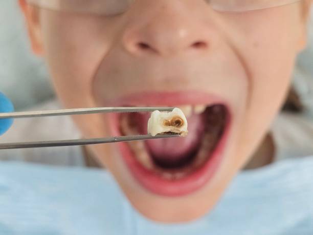 Best Emergency Dentist for Knocked-Out Tooth in Berry Hill, TN
